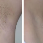 Lumi™ IPL Laser Hair Removal Handset