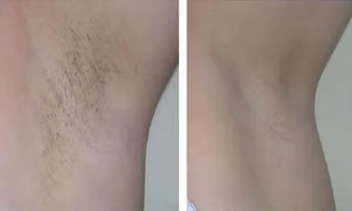 Lumi™ IPL Laser Hair Removal Handset photo review