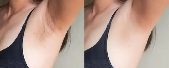 Lumi™ IPL Laser Hair Removal Handset photo review