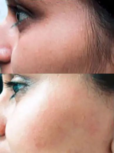 Lumi™ IPL Laser Hair Removal Handset photo review