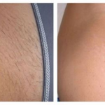 Lumi™ IPL Laser Hair Removal Handset