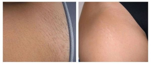 Lumi™ IPL Laser Hair Removal Handset photo review