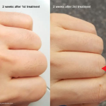 Lumi™ IPL Laser Hair Removal Handset