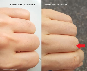 Lumi™ IPL Laser Hair Removal Handset photo review