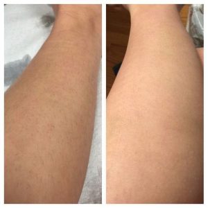 Lumi™ IPL Laser Hair Removal Handset photo review