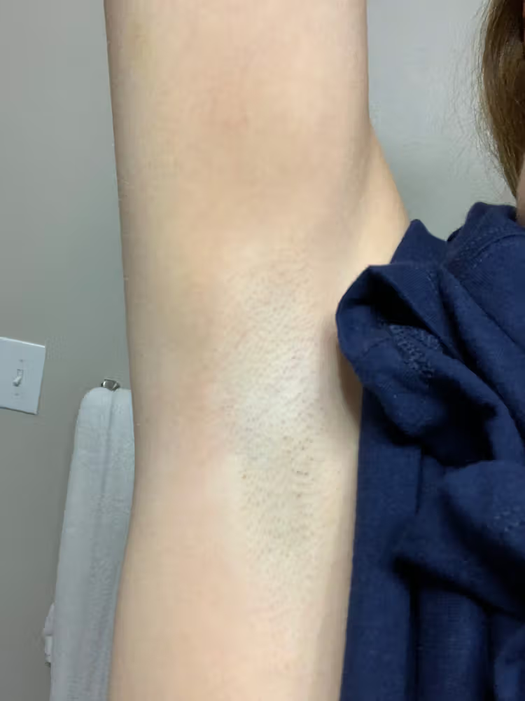 Lumi™ IPL Laser Hair Removal Handset photo review