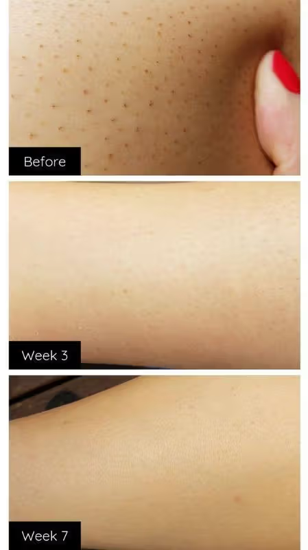 Lumi™ IPL Laser Hair Removal Handset photo review