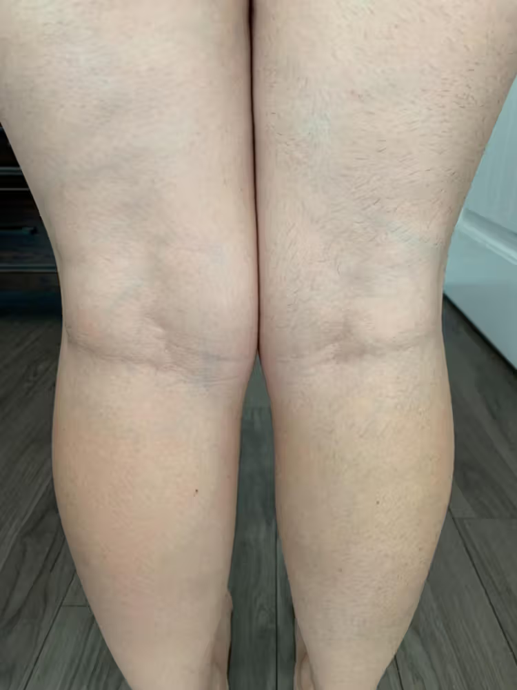 Lumi™ IPL Laser Hair Removal Handset photo review